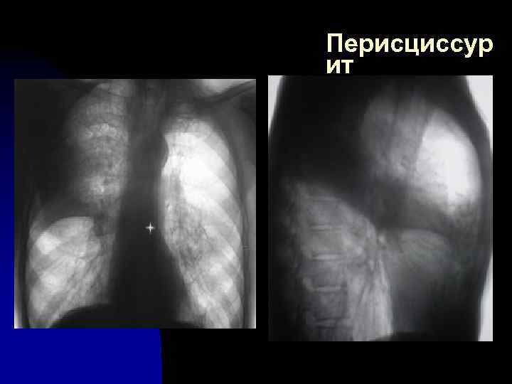 Перисциссур ит 