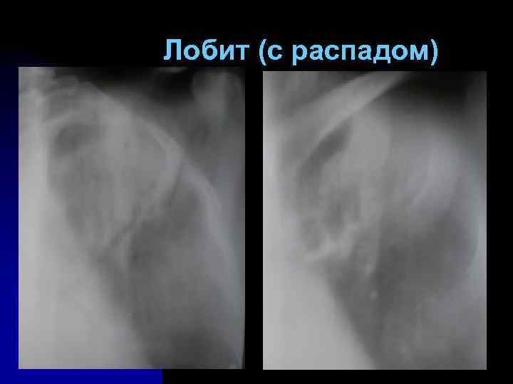 Лобит (с распадом) 