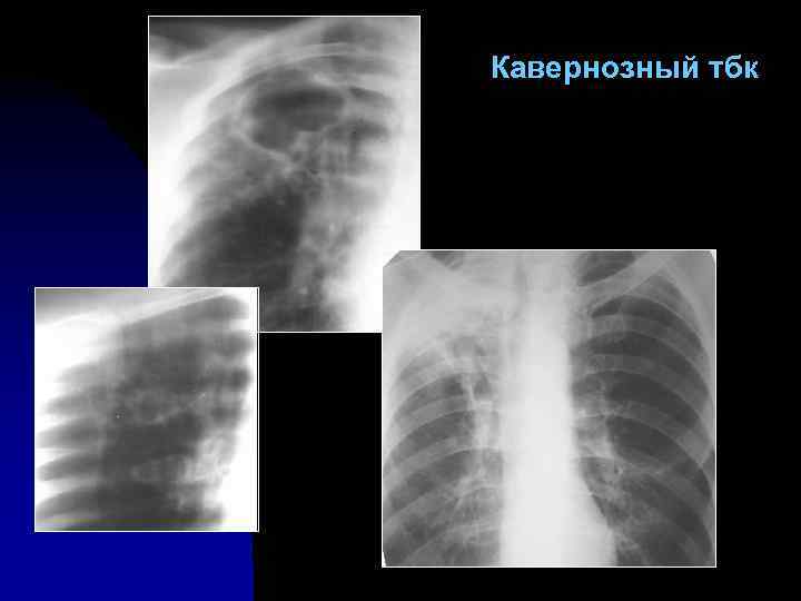 Кавернозный тбк 