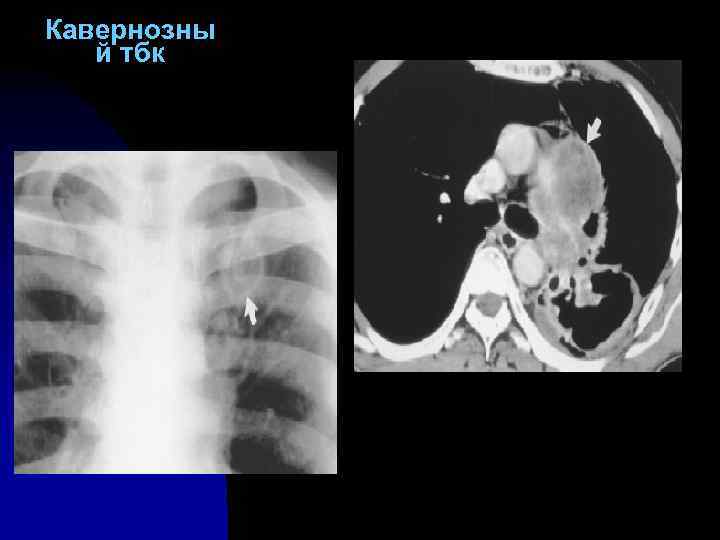 Кавернозны й тбк 