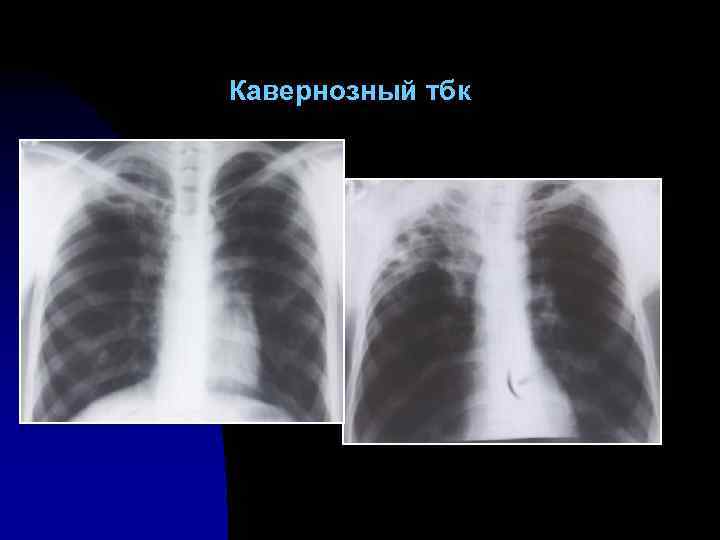 Кавернозный тбк 