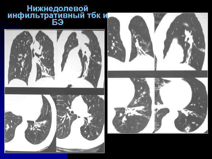 Нижнедолевой инфильтративный тбк и БЭ 