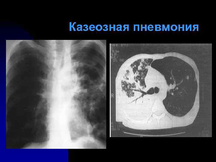 Казеозная пневмония 