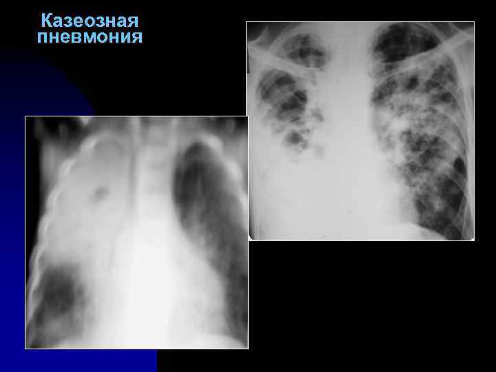 Казеозная пневмония 