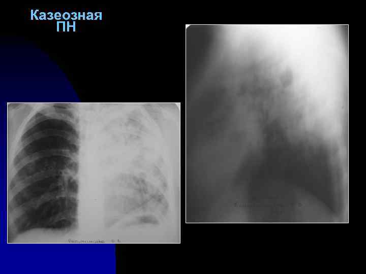 Казеозная ПН 