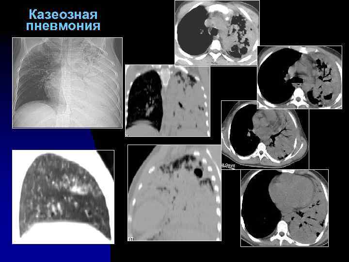 Казеозная пневмония 
