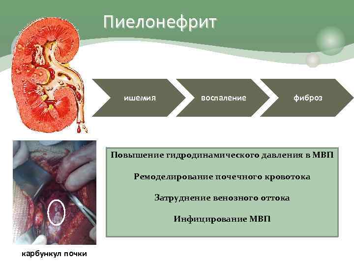 Пиелонефрит ишемия воспаление фиброз Повышение гидродинамического давления в МВП Ремоделирование почечного кровотока Затруднение венозного