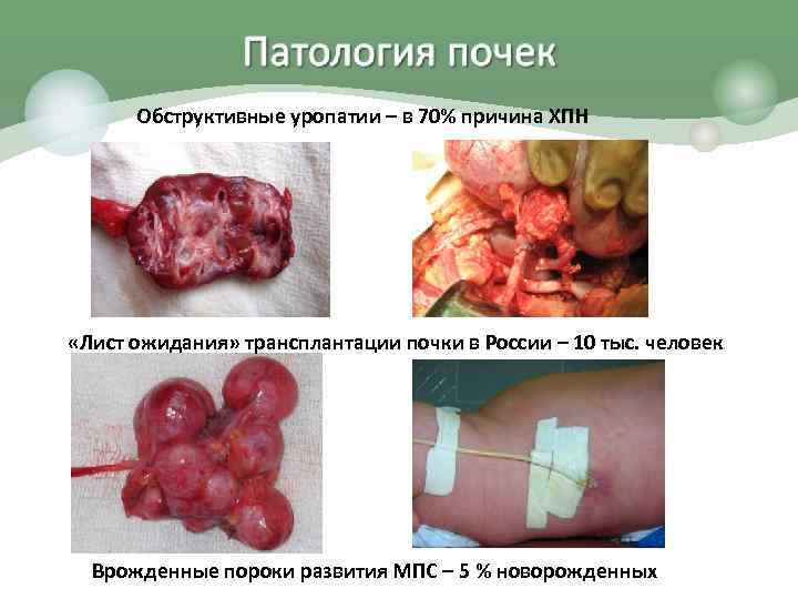 Обструктивные уропатии – в 70% причина ХПН «Лист ожидания» трансплантации почки в России –