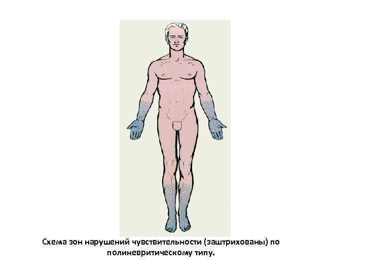 Нарушение ч. Полиневритический Тип чувствительности. Расстройство чувствительности по полиневритическому типу. Полиневритический Тип нарушения чувствительности. Нарушение чувствительности по типу носков.