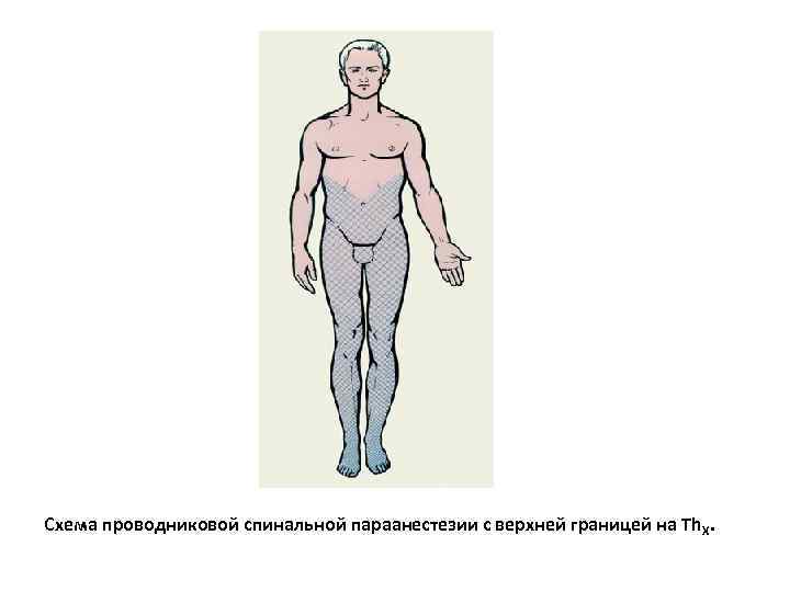 Схема проводниковой спинальной параанестезии с верхней границей на Th X. 