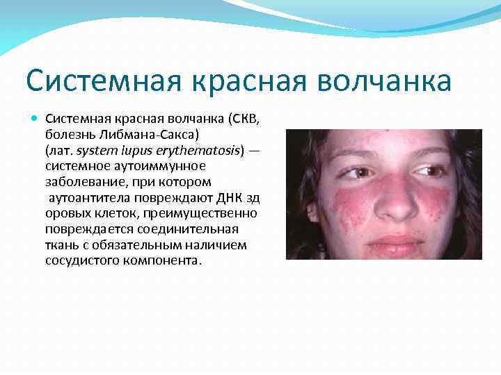 Системная красная волчанка (СКВ, болезнь Либмана-Сакса) (лат. system lupus erythematosis) — системное аутоиммунное заболевание,