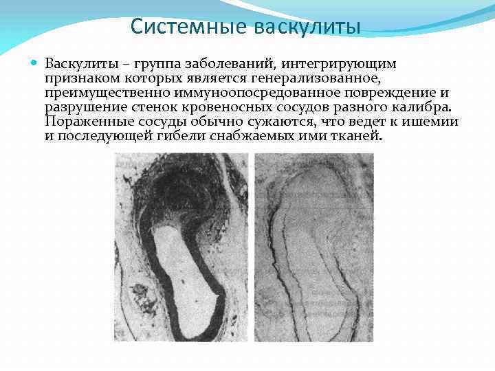 Системные васкулиты Васкулиты – группа заболеваний, интегрирующим признаком которых является генерализованное, преимущественно иммуноопосредованное повреждение