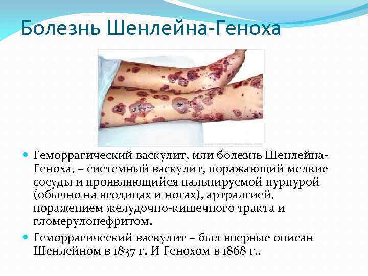 Болезнь Шенлейна-Геноха Геморрагический васкулит, или болезнь Шенлейна. Геноха, – системный васкулит, поражающий мелкие сосуды