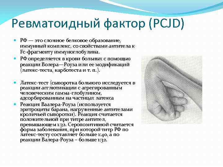 Ревматоидный фактор (PCJD) РФ — это сложное белковое образование, иммунный комплекс, со свойствами антитела