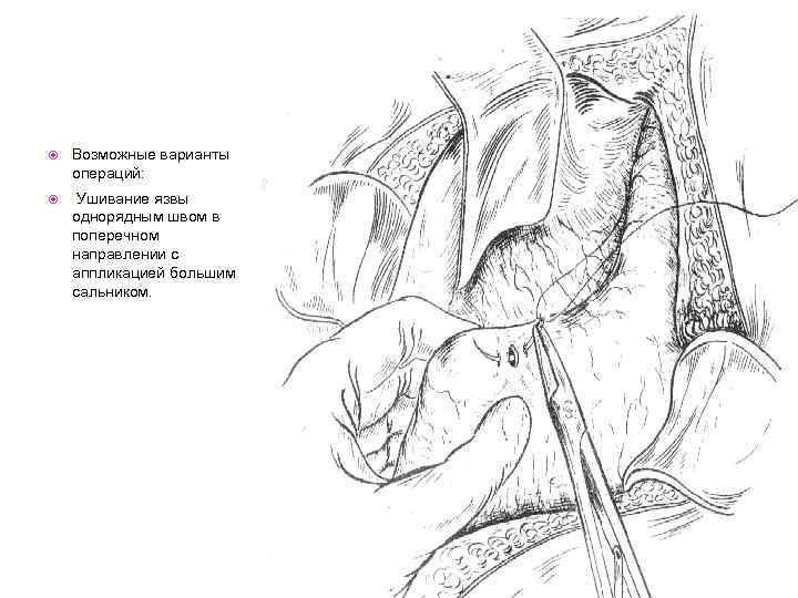 Возможные варианты операций: Ушивание язвы однорядным швом в поперечном направлении с аппликацией большим