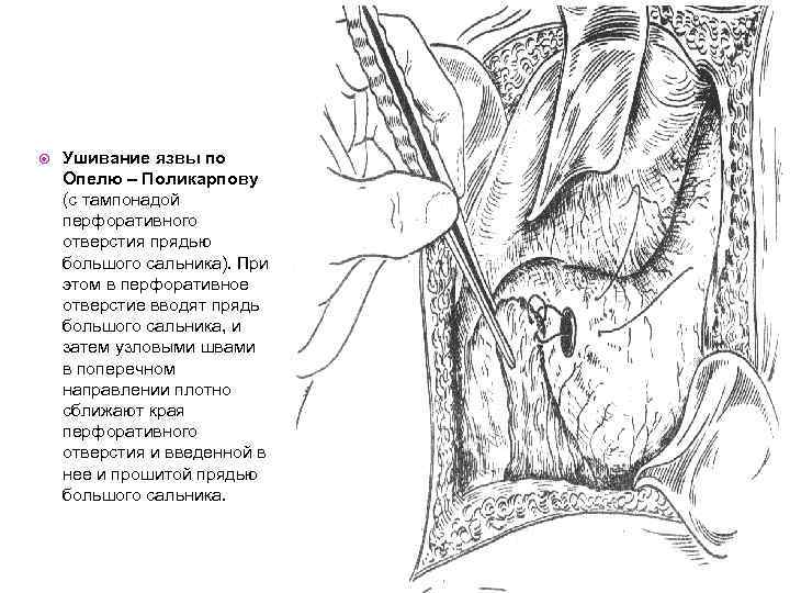  Ушивание язвы по Опелю – Поликарпову (с тампонадой перфоративного отверстия прядью большого сальника).
