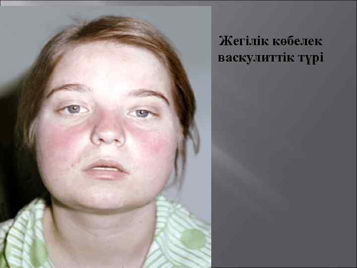 Жегілік көбелек васкулиттік түрі 