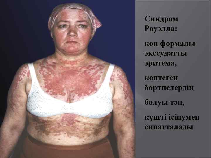 Синдром Роуэлла: көп формалы экссудатты эритема, көптеген бөртпелердің болуы тән, күшті ісінумен сипатталады 
