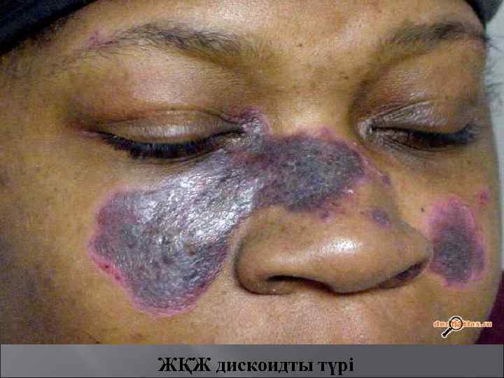 ЖҚЖ дискоидты түрі 