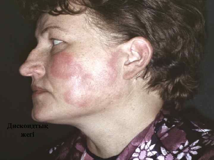 Дискоидтық жегі 