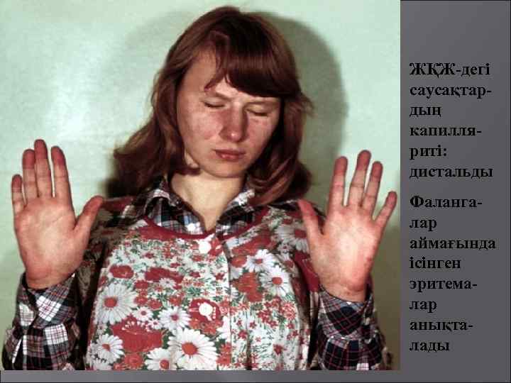 ЖҚЖ-дегі саусақтардың капилляриті: дистальды Фалангалар аймағында ісінген эритемалар анықталады 