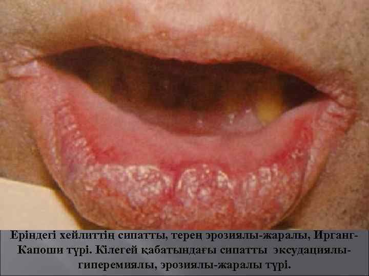 Еріндегі хейлиттің сипатты, терең эрозиялы-жаралы, Ирганг. Капоши түрі. Кілегей қабатындағы сипатты эксудациялыгиперемиялы, эрозиялы-жаралы түрі.