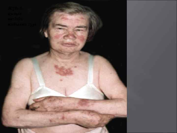 Жүйелі қызыл жегінің жайылма түрі 