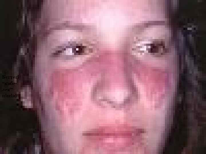 Беттегі “көбелек” пішіні 