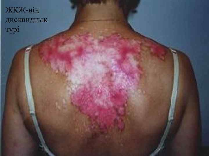 ЖҚЖ-нің дискоидтық түрі 