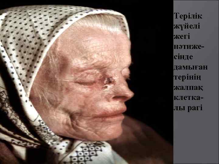 Терілік жүйелі жегі нәтижесінде дамыған терінің жалпақ клеткалы рагі 