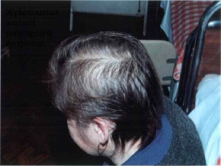 Жүйелі қызыл жегідегі шаштардағы өзгерістер 