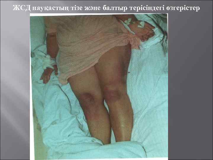 ЖСД науқастың тізе және балтыр терісіндегі өзгерістер 