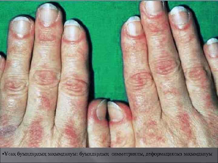  • Ұсақ буындардың зақымдануы: буындардың симметриялы, деформациясыз зақымдануы 