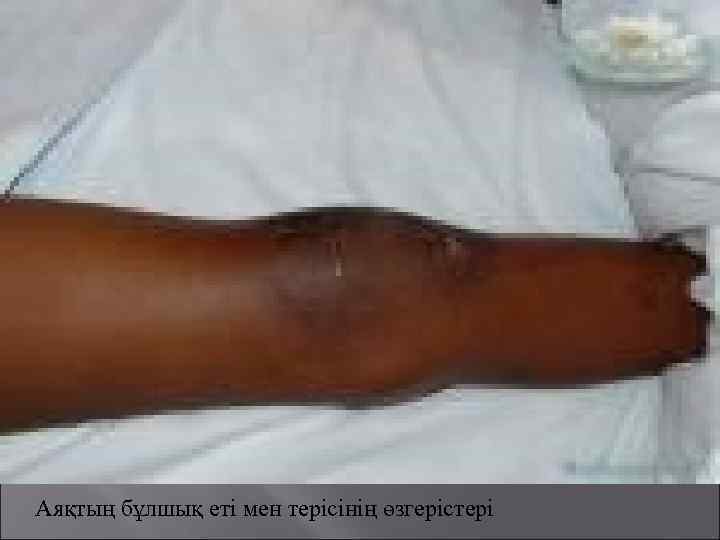 Аяқтың бұлшық еті мен терісінің өзгерістері 