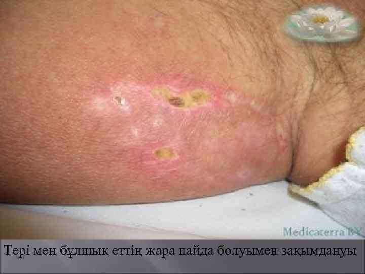 Тері мен бұлшық еттің жара пайда болуымен зақымдануы 