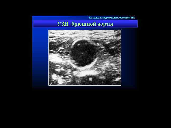 Кафедра хирургических болезней № 1 УЗИ брюшной аорты 