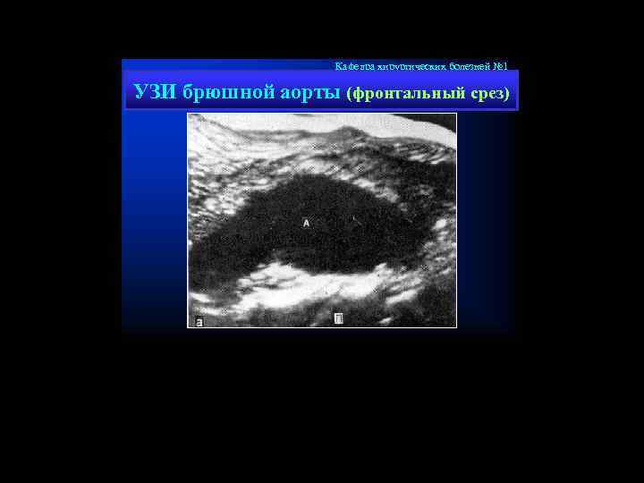 Кафедра хирургических болезней № 1 УЗИ брюшной аорты (фронтальный срез) 