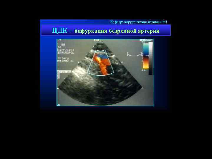 Кафедра хирургических болезней № 1 ЦДК – бифуркация бедренной артерии 