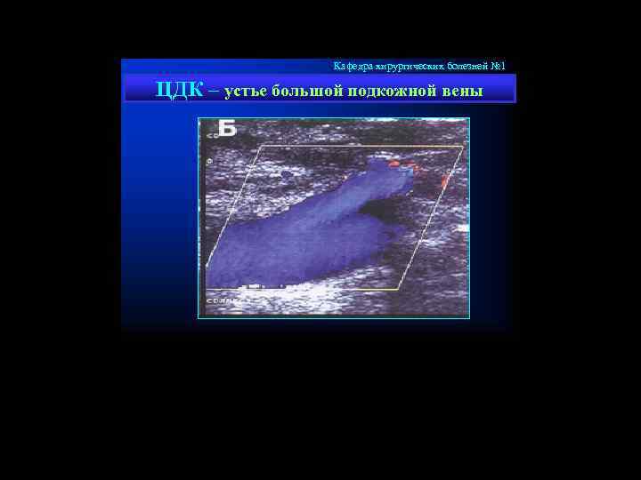 Кафедра хирургических болезней № 1 ЦДК – устье большой подкожной вены 