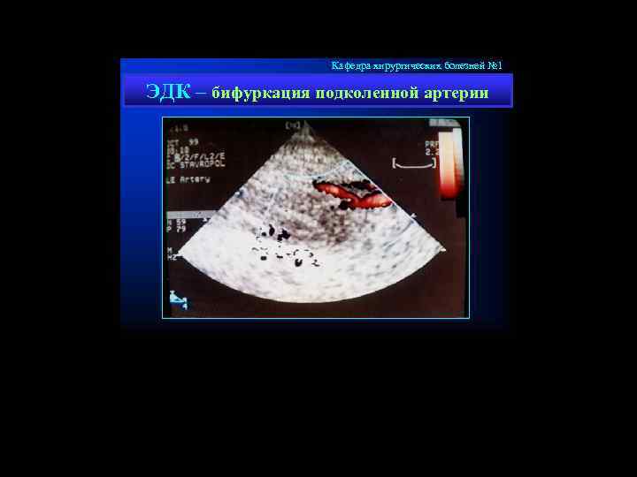 Кафедра хирургических болезней № 1 ЭДК – бифуркация подколенной артерии 