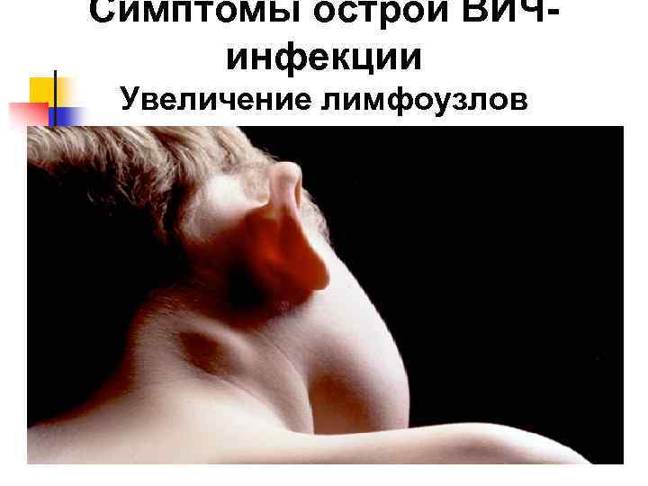 Симптомы острой ВИЧинфекции Увеличение лимфоузлов 