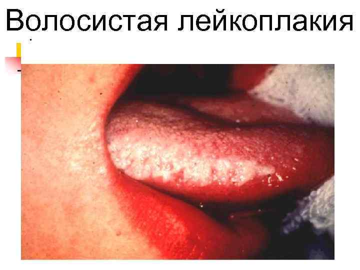Волосистая лейкоплакия 