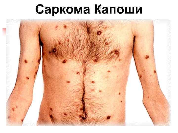 Саркома Капоши 