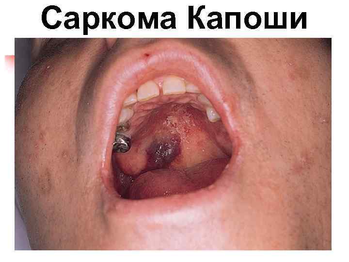 Саркома Капоши 