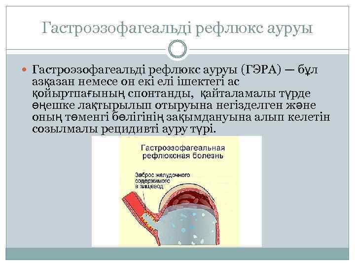 Гастроэзофагеальді рефлюкс ауруы (ГЭРА) — бұл азқазан немесе он екі елі ішектегі ас қойыртпағының