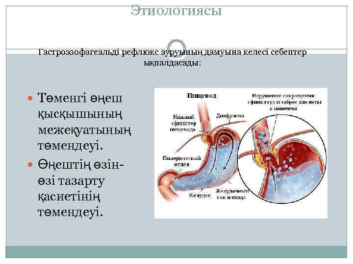 Этиологиясы Гастроэзофагеальді рефлюкс ауруының дамуына келесі себептер ықпалдасады: Төменгі өңеш қысқышының межеқуатының төмендеуі. Өңештің