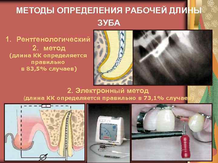 МЕТОДЫ ОПРЕДЕЛЕНИЯ РАБОЧЕЙ ДЛИНЫ ЗУБА 1. Рентгенологический 2. метод (длина КК определяется правильно в