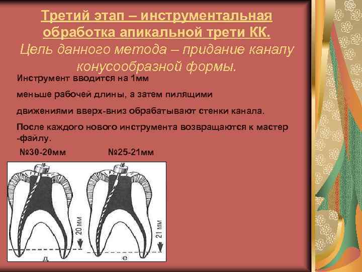 Этапы эндодонтического лечения