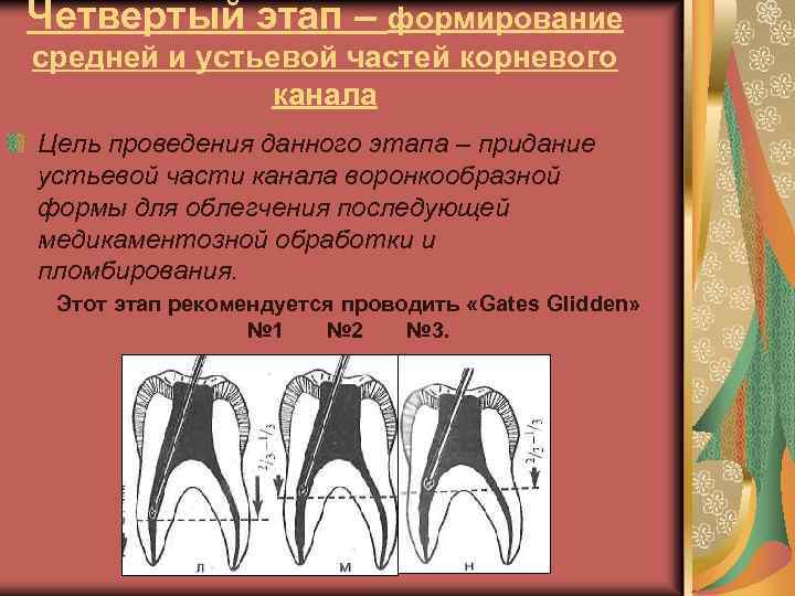 Этап iv. Формирование корневого канала. Средняя треть корневого канала. Устьевая часть корневого канала. Герметизация устьевой части корневого канала.