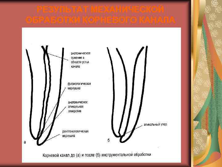 РЕЗУЛЬТАТ МЕХАНИЧЕСКОЙ ОБРАБОТКИ КОРНЕВОГО КАНАЛА 